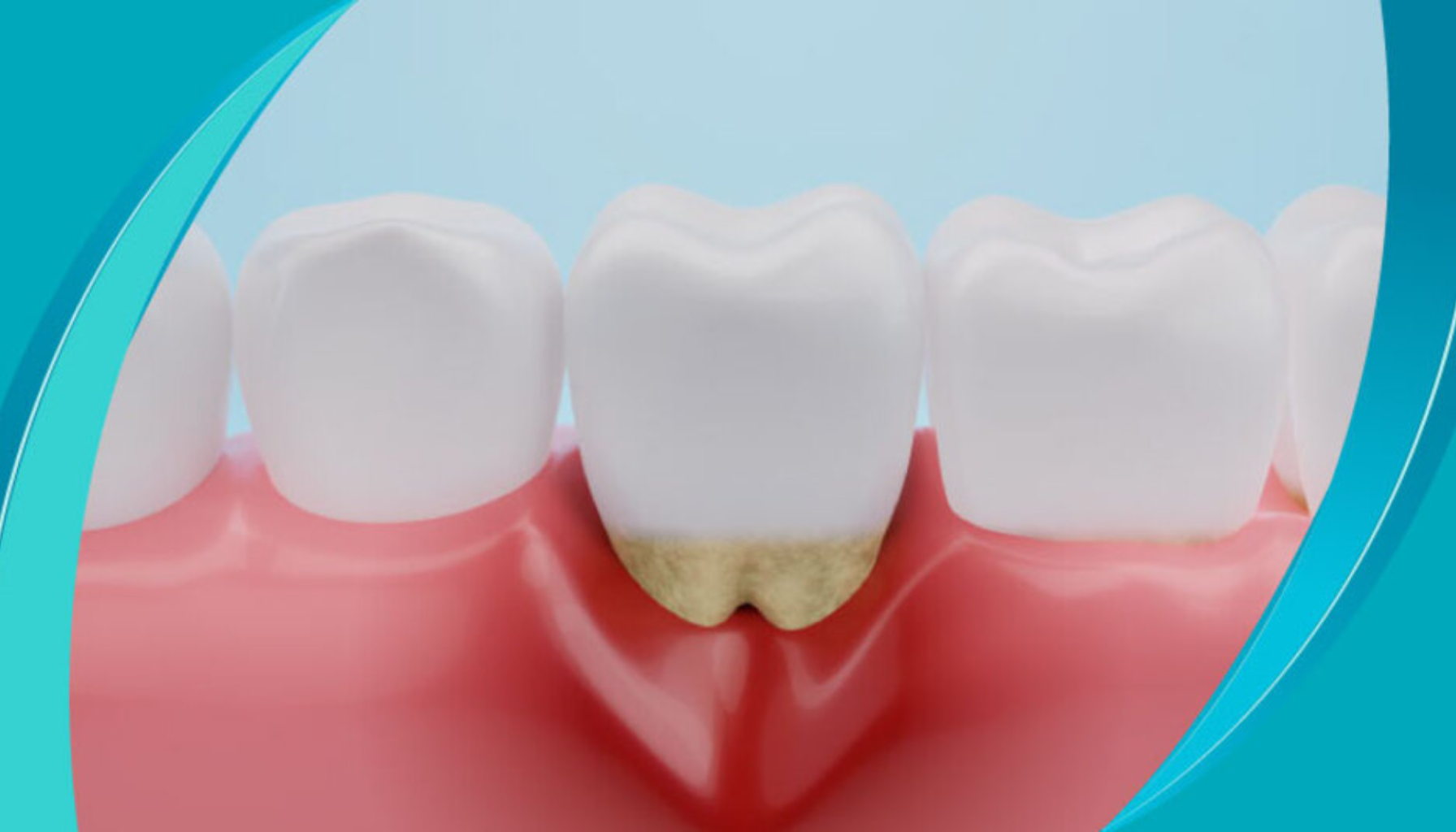 Kul i tannkjøttet – Bør du bekymre deg? Dette må du vite 11 Illustrasjon av tannstein under tannkjøttet på en jeksel, viser opphopning av belegg som kan føre til tannkjøttbetennelse.