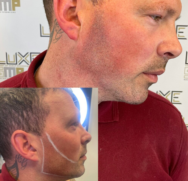 Facial Micropigmentation Plan at https://luxesmpclinic.co.uk/facial-micropigmentation