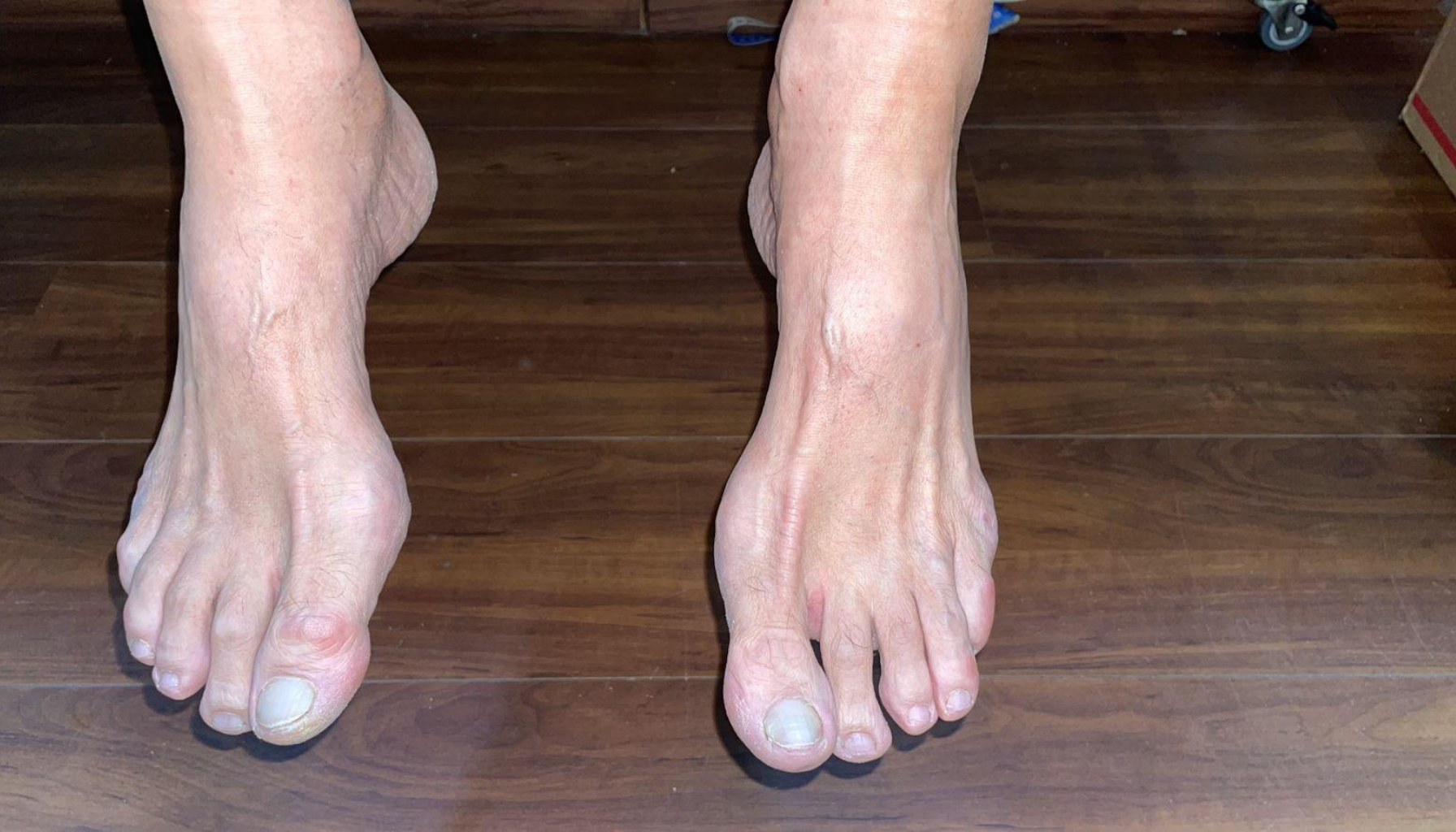 Føtter med tydelig hallux valgus, storetå som peker innover og hevelse ved tåleddet.