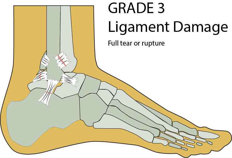 image ligament damage grade 3