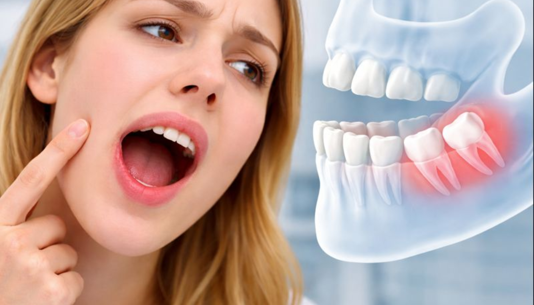 Får Alle Visdomstenner? Myten og Fakta om Tredje Jeksel 11 Ung kvinne peker på kjeve med åpnet munn, visdomstenner vises i gjennomsiktig røntgenillustrasjon ved siden av.