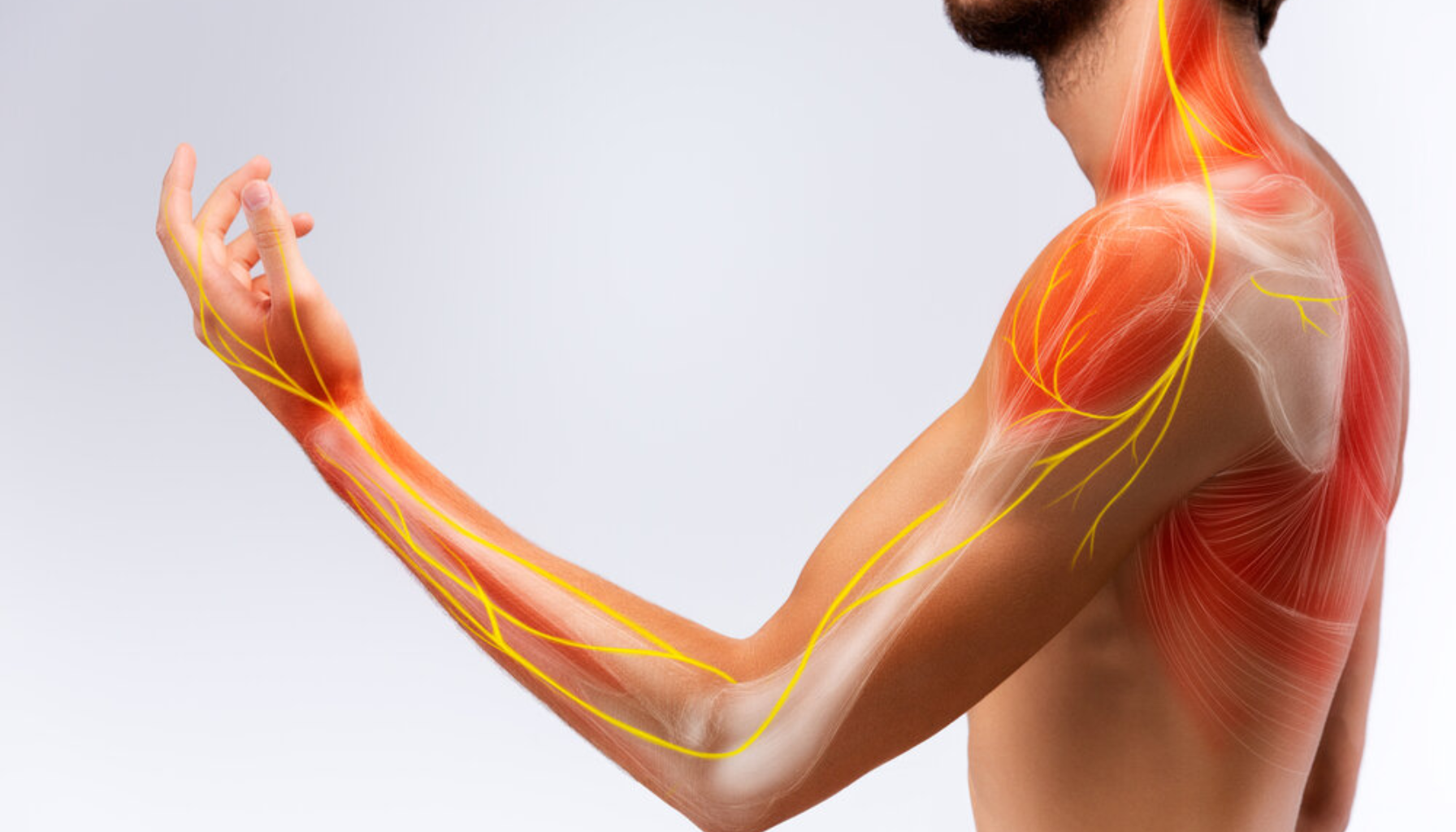 Synlige nerver og muskler i arm/skulder illustrerer utstrålende smerter.