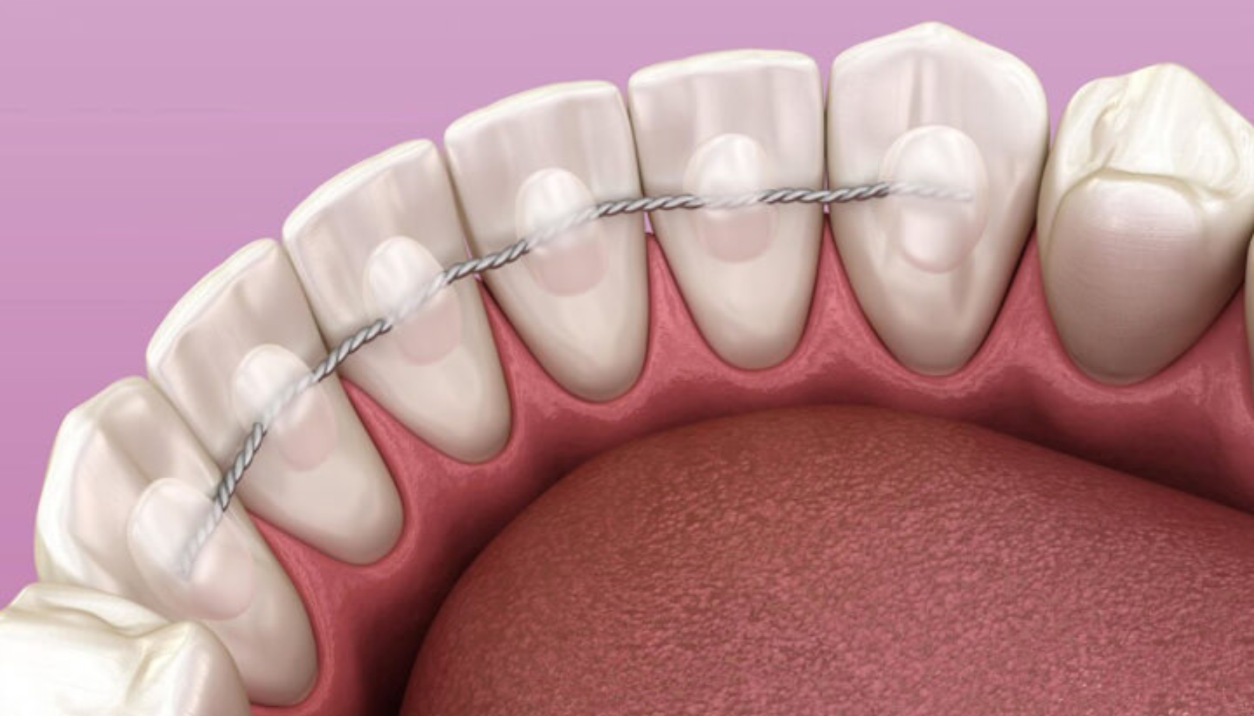 Streng bak tennene løsnet: Hva gjør du?