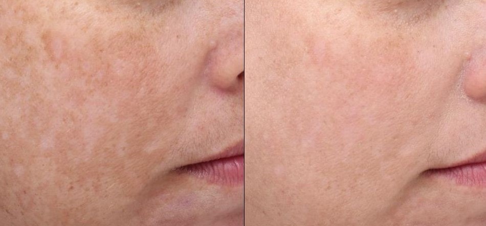 Before and after MOXI laser treatments showing smoother skin texture and reduced age spots on the cheek following a personalized approach.
