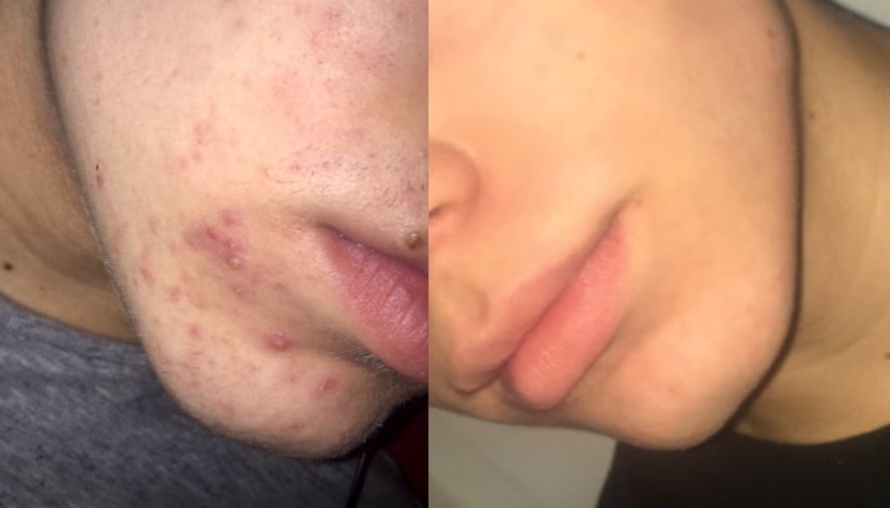 Før- og etterbilde av hake og kinn viser tydelig forbedring i akne og hudkvalitet etter behandling mot uren hud.