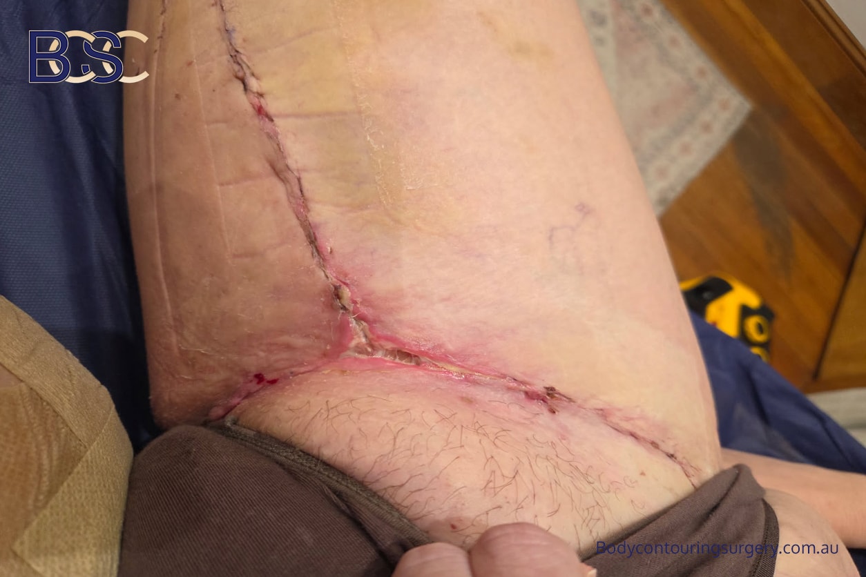 Wound breakdown in the T junction of a full Thighplasty