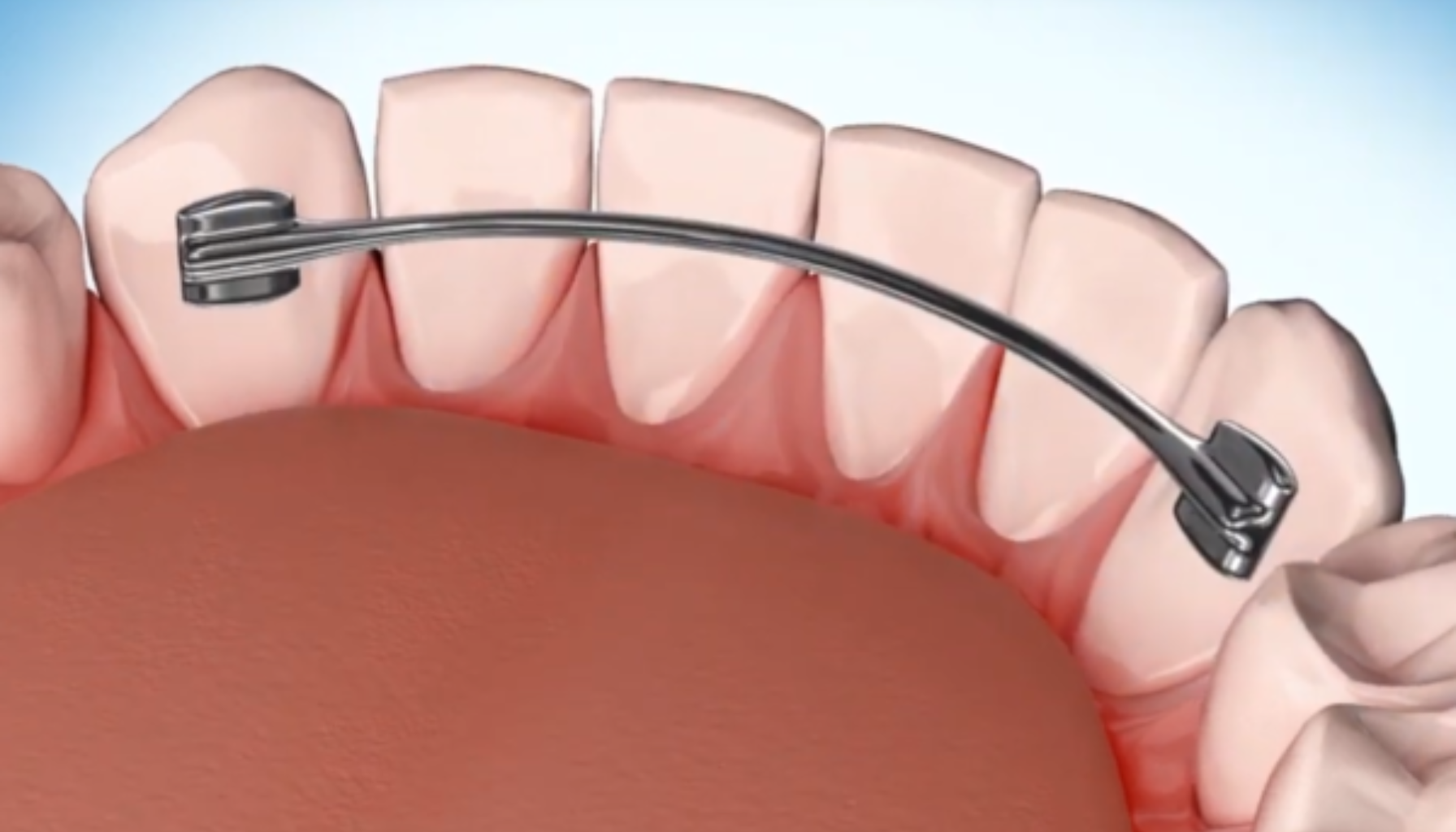 Streng bak tennene løsnet: Hva gjør du nå? 9 Illustrasjon av tynnt metallanker festet bak fortennene som viser hvordan en lingual retainer fungerer.