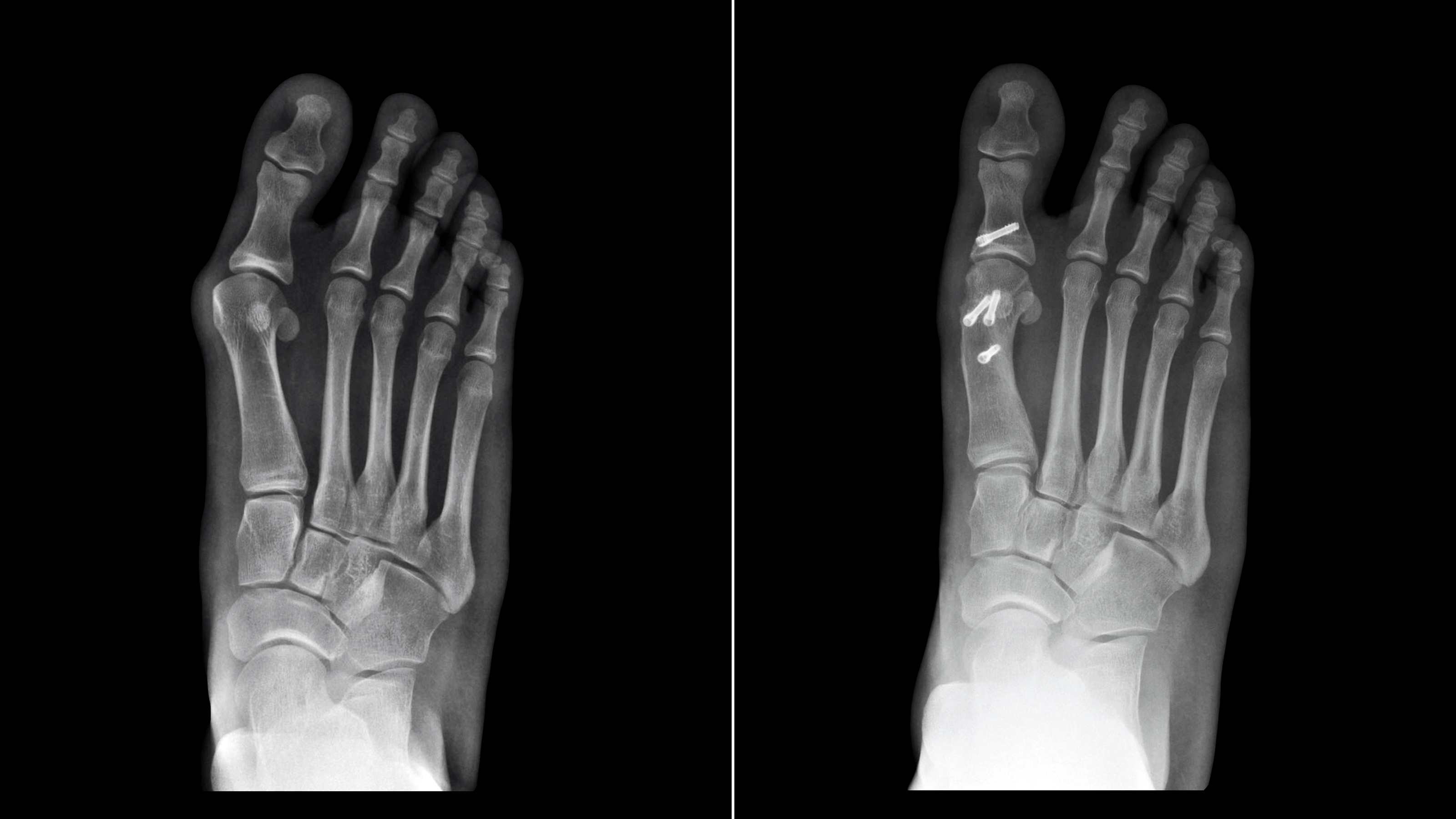 Röntgenbilder som visar en fot före och efter operation av hallux valgus
