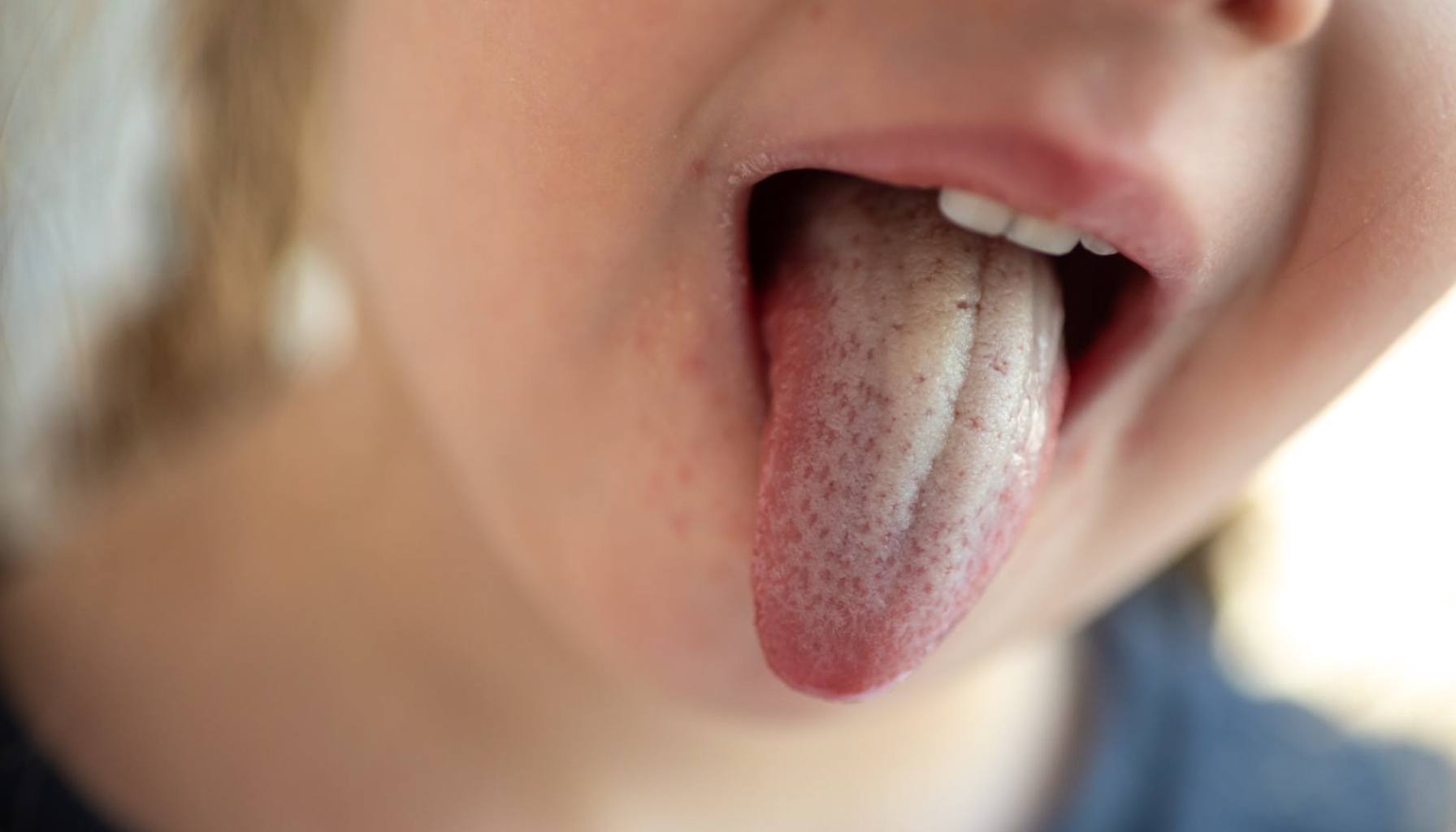 Trøske i Munnen: Ikke Bare for Babyer 17 Barn med hvitt belegg og misfarging på tungen, mulige tegn på soppinfeksjon eller dårlig munnhygiene.