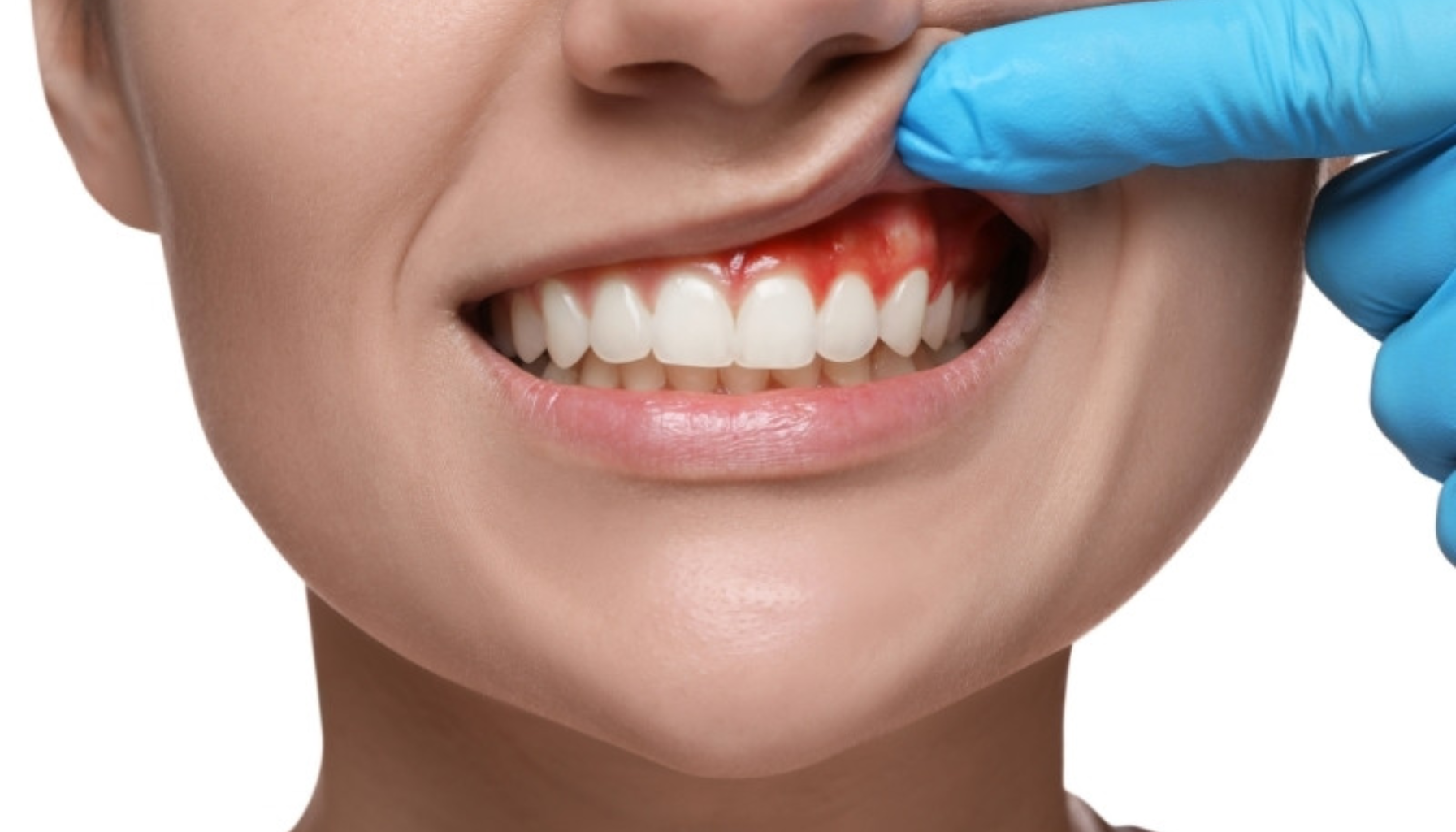 Blemme på Tannkjøttet: Når Små Hevelser Er Et Tegn på Irritasjon eller Infeksjon 14 Nærbilde av smil med blødende tannkjøtt, hanskekledd finger løfter leppe for å vise betennelse rundt fortennene tydelig smertefull