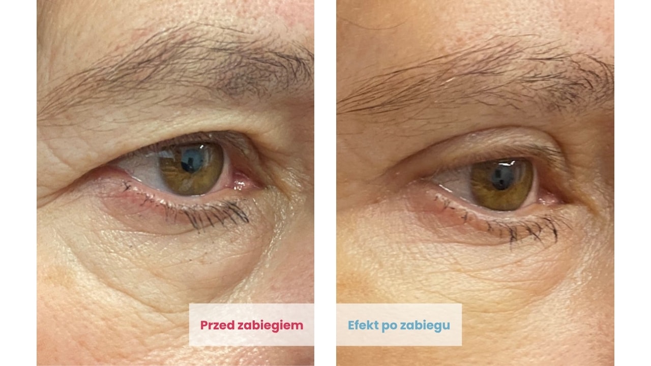 Efekty plastyki powiek górnych u Pacjentki kobiety