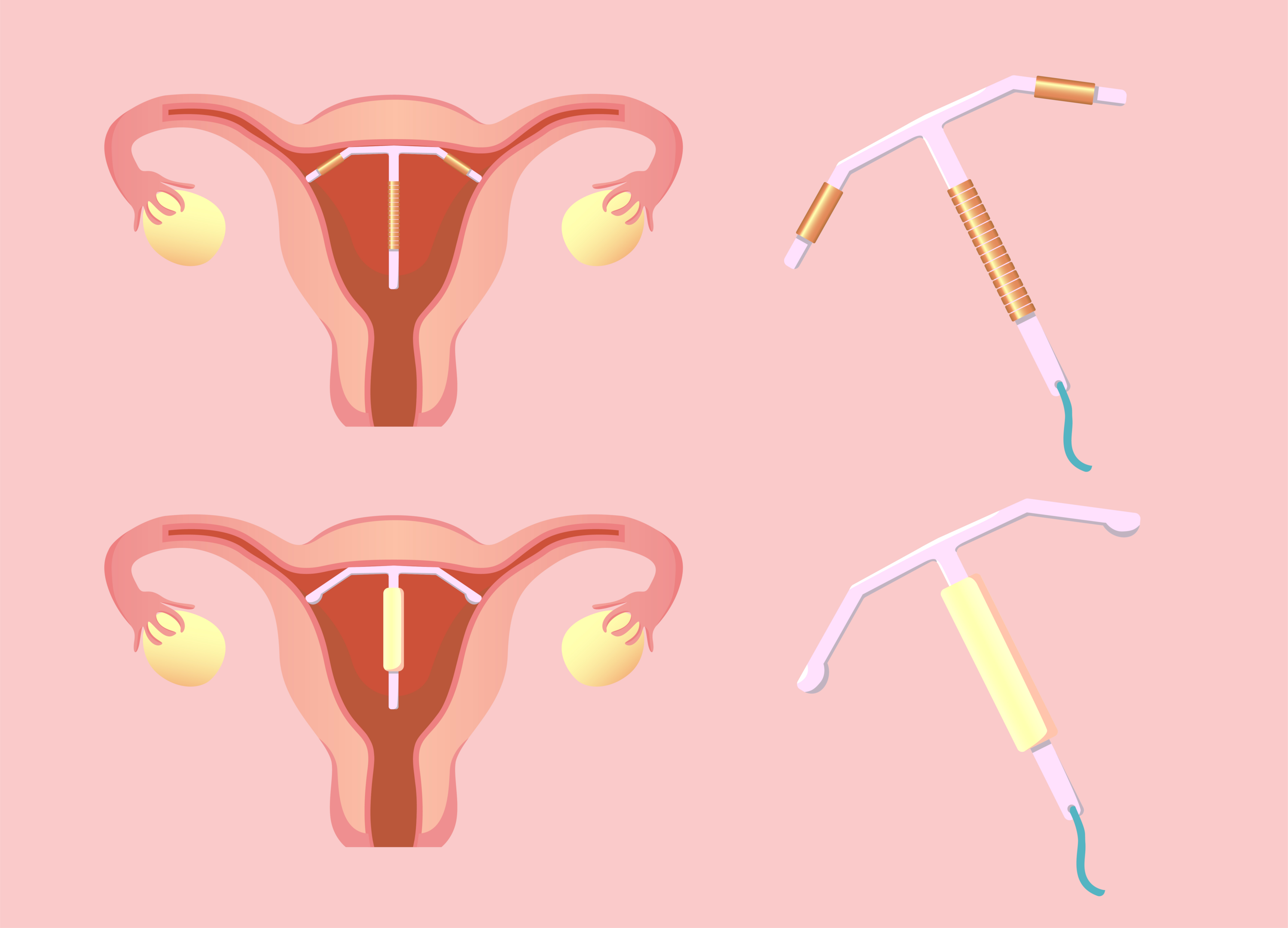 An illustration showing the use of both types of IUDs.