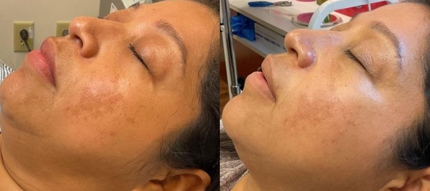 MOXI laser session on darker skin tones improves uneven skin tone with minimal downtime using non ablative laser guided by a treatment plan.