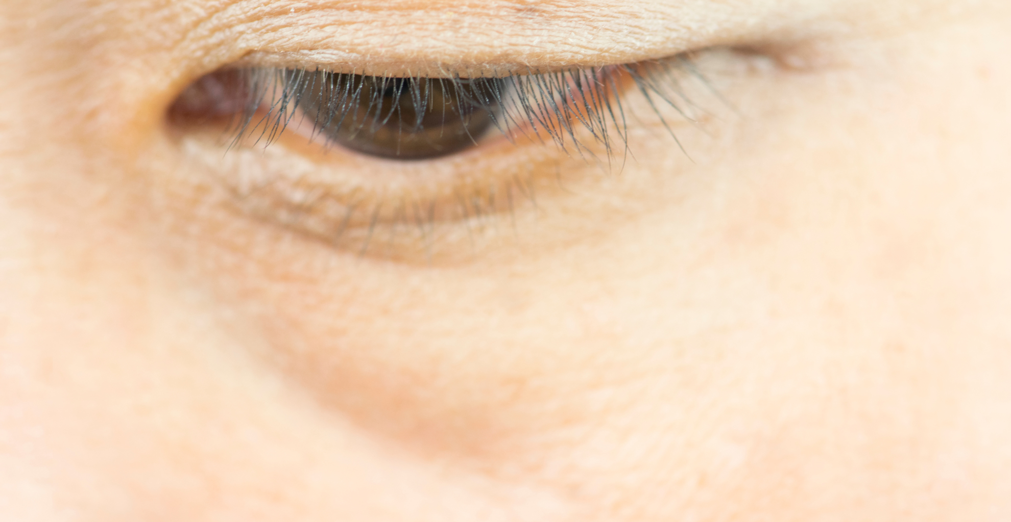Augenringe sind ein nach außen sichtbares Zeichen oft schlechter Gesundheit.