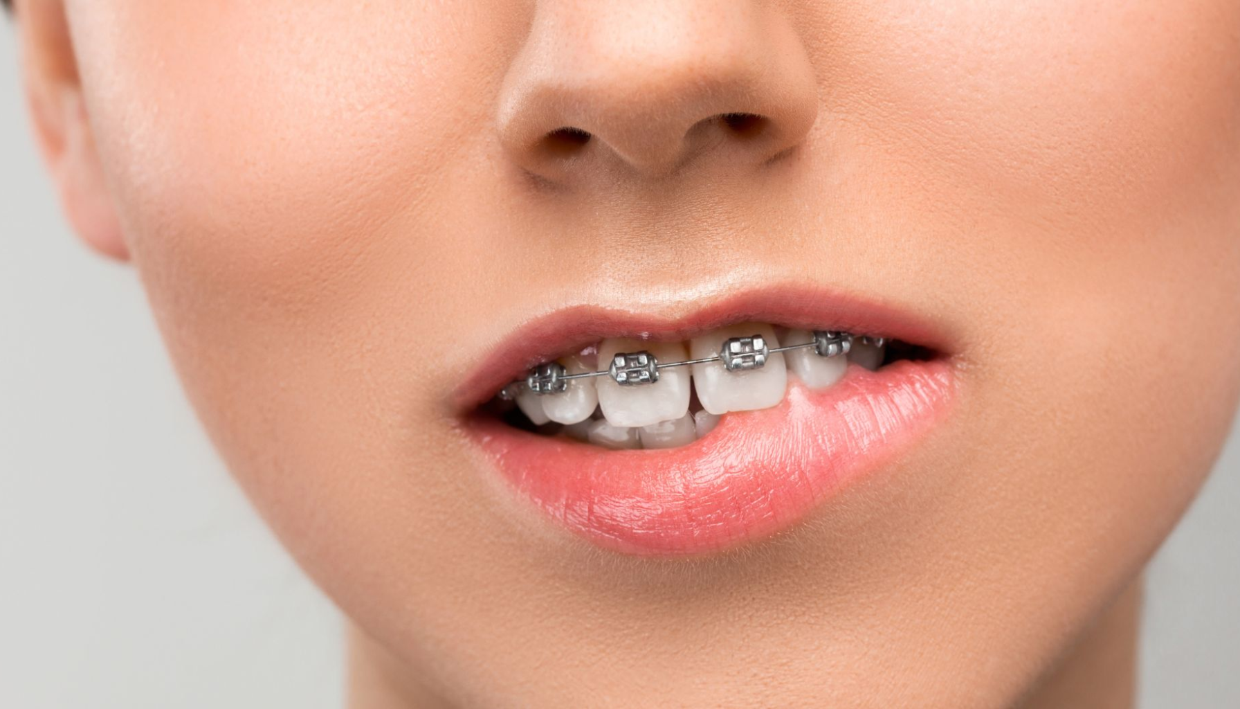 Nærbilde av munn med tannregulering, metallbraketter og streng synlige på fortennene, viser behandling av skjeve tenner hos ungdom eller voksen.