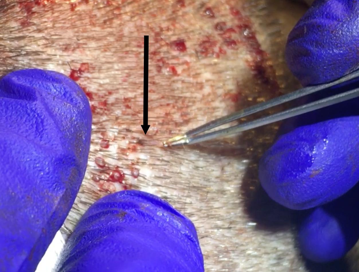 Dr Vikas Kunnure - Grafts extracted after excised - Pulled out by Technician.