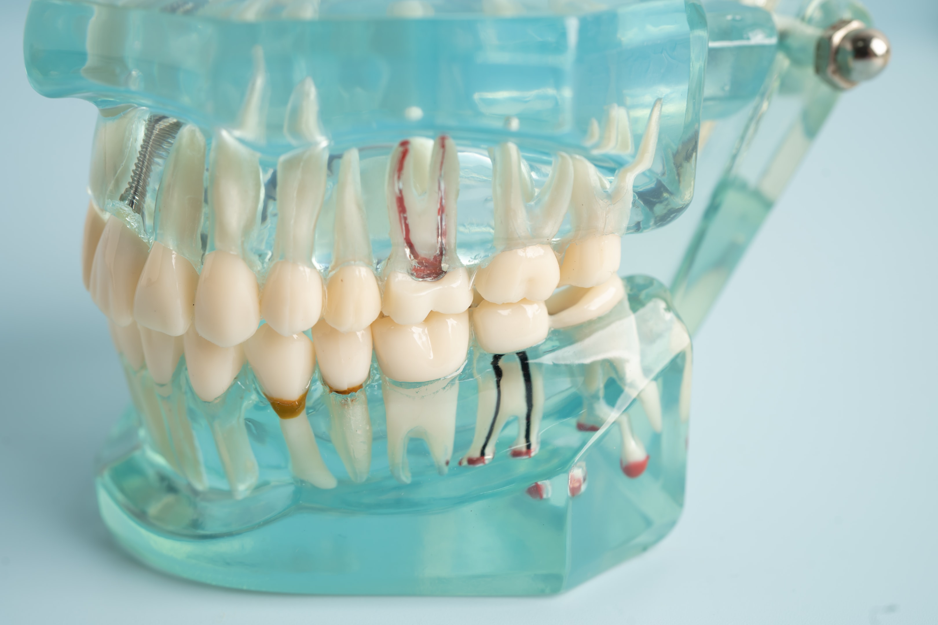dental model showing the placement of wisdom teeth in the mouth
