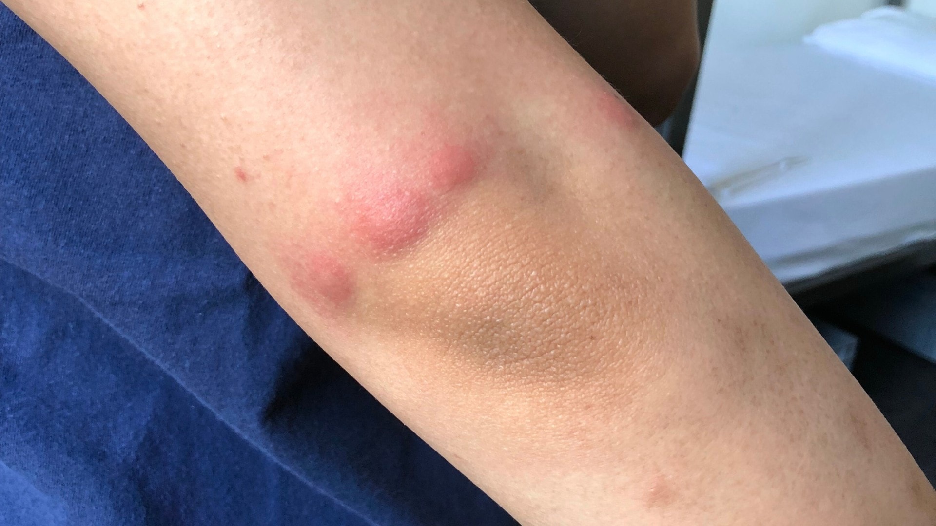 Bed bug bites on a person's arm above the elbow.