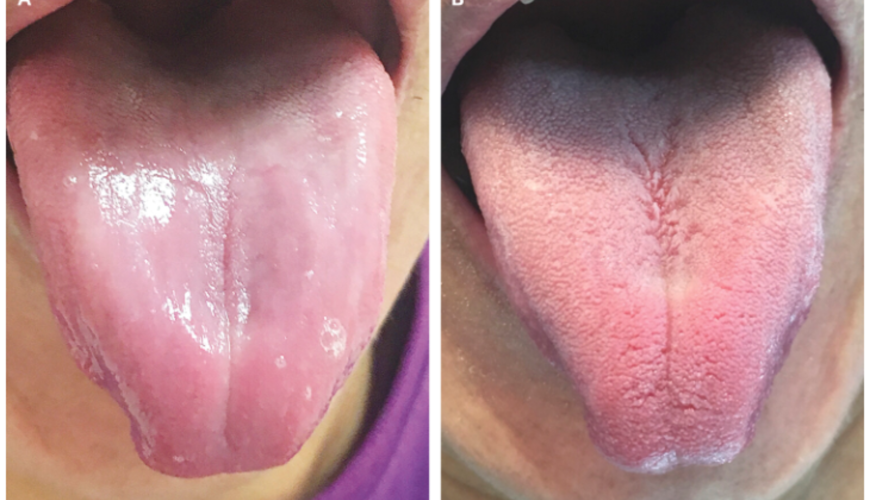 Glossitt – Når tungen blir betent og smertefull 19 Sammenligning av to tunger – én glatt og betent, én med normal tekstur – viser symptomer på glossitt hos voksen pasient. glossitt geografisk tunge hos barn tungen tunge sår symptomer munnen behandling årsaker hos eksempel ofte brennende betennelse andre infeksjoner mer tilstanden symptomene munnhulen føre tegn smerte syndrom forandringer tilfeller barn tilstander bør flere små skyldes munnslimhinnen tilstand årsaken bakterier utvikle enkelte finnes oral personer tilbake del smerter svie endringer søk følelse form vanlig soppinfeksjoner lett soppinfeksjon annet utsatt vitamin alvorlig forårsake imidlertid kvinner mye sjeldne krever trenger