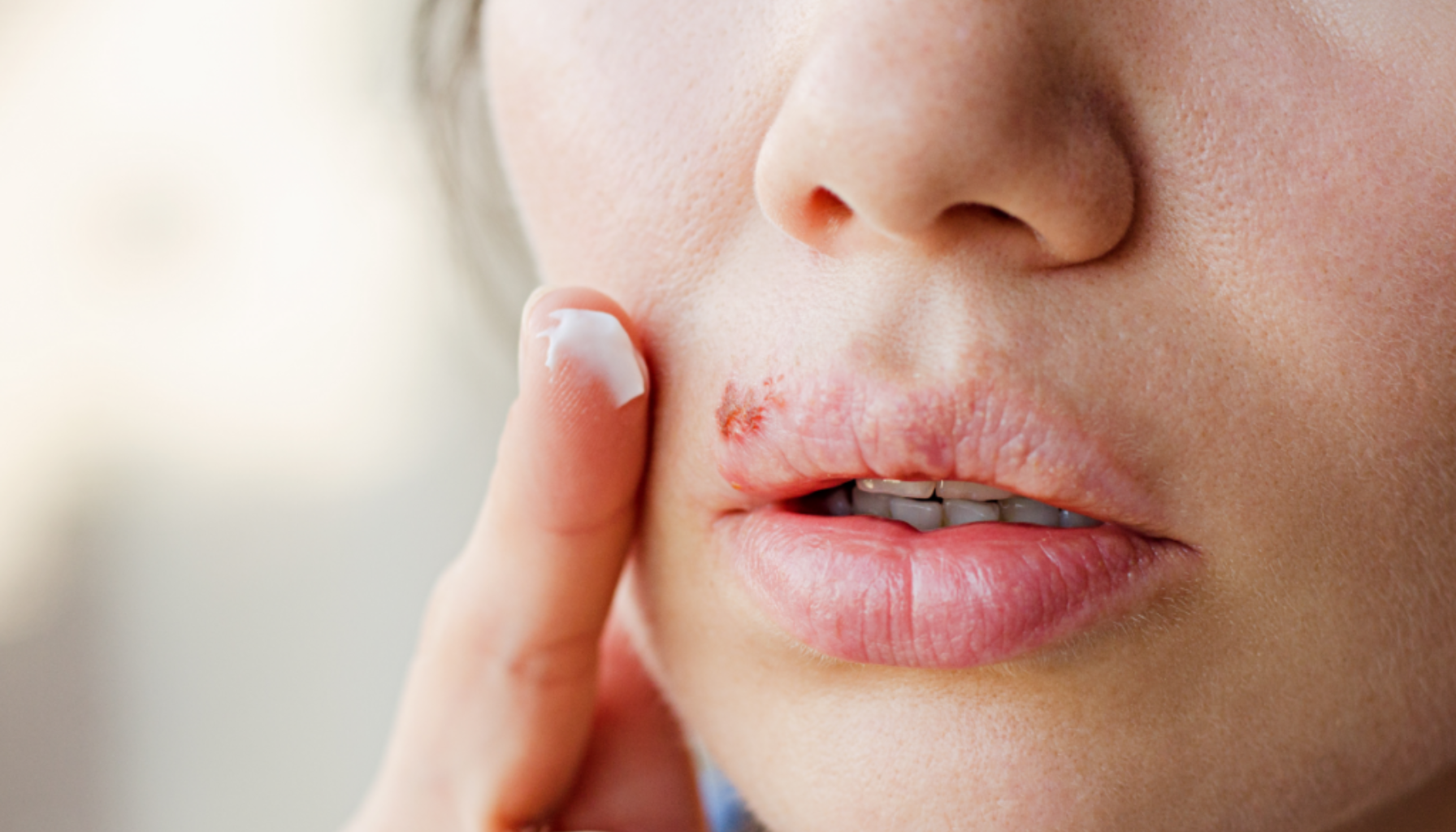 Kvinne påfører krem på leppen med forkjølelsessår (herpesutbrudd) for behandling av sår og irritasjon på huden. herpes herpes simplex virus genital herpes herpes simplex virus type simplex virus type 1 antivirale midler type 1 hsv 2 første utbrudd resten av livet hsv 1 type 2 hud og slimhinner første utbruddet nye utbrudd behandling med antivirale smertefulle blemmer hyppige utbrudd utbrudd hsv nedsatt allmenntilstand behandling under fødselen viruset hos smitte sår 10 dager symptomer herpesvirus ofte sykdom under får infeksjon første smittet forkjølelsessår antivirale rundt gir finnes dager fleste herpesutbrudd blemmer barn bør svært residiv underlivet smertefulle utbruddet andre hud lege mor kroppen sårene barnet vanligvis munnen uker aciklovir vanlig kalles gjennom behandlingen huden sex eksempel mulig symptomene dersom tabletter smitter infeksjoner derfor sykdommen legemidler