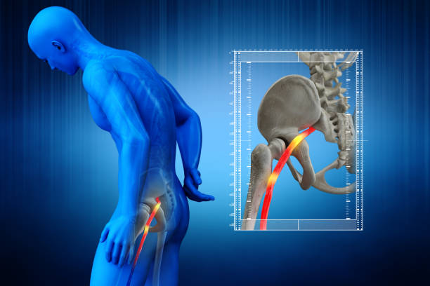 Sciatica is pain from the sciatic nerve. A group of nerves which travel from the spine to your foot.