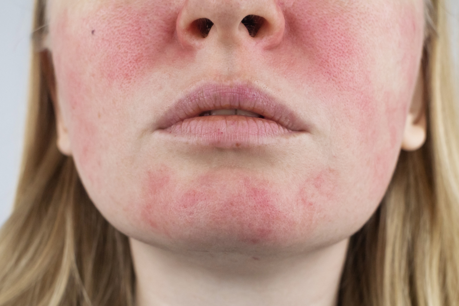 Person with flushed face and visible redness.