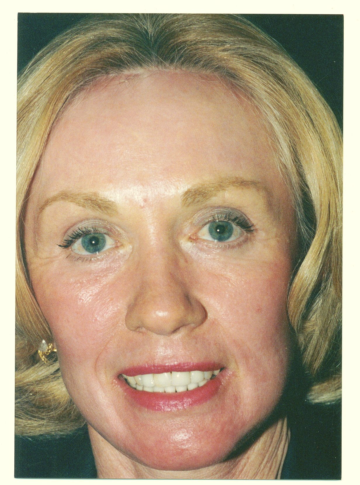 Full Facelift including browlift,eyelid surgery and Laser resurface - After