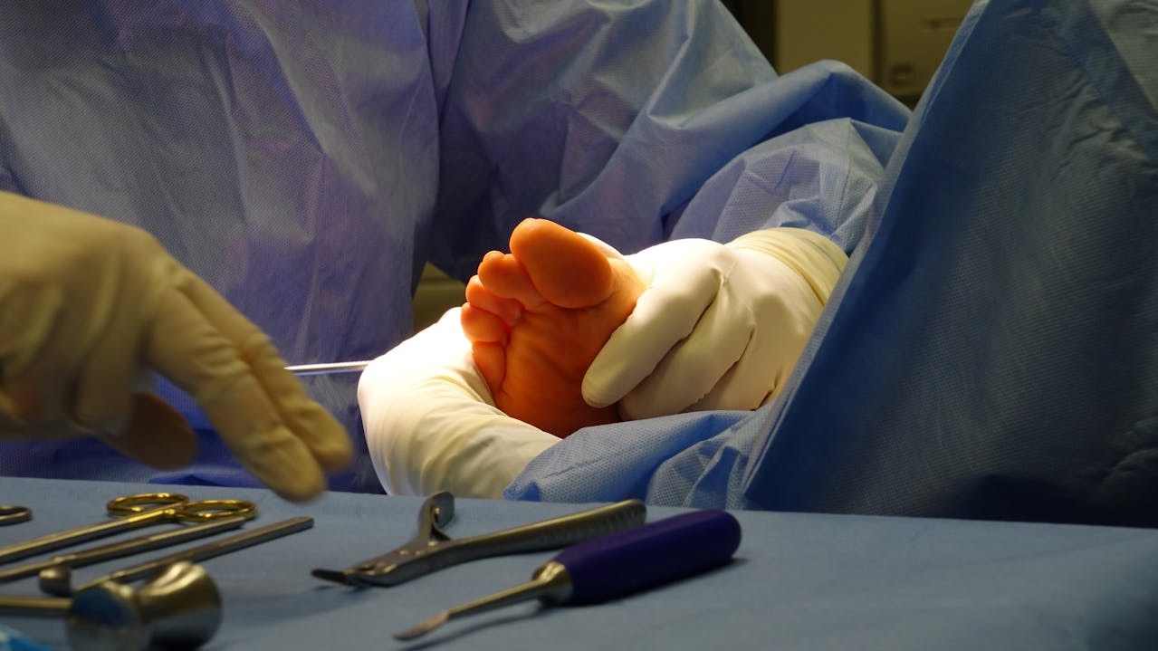 Patient’s foot draped for surgery with surgical tools nearby, showing a real operating setup for types of bunionectomy surgery.
