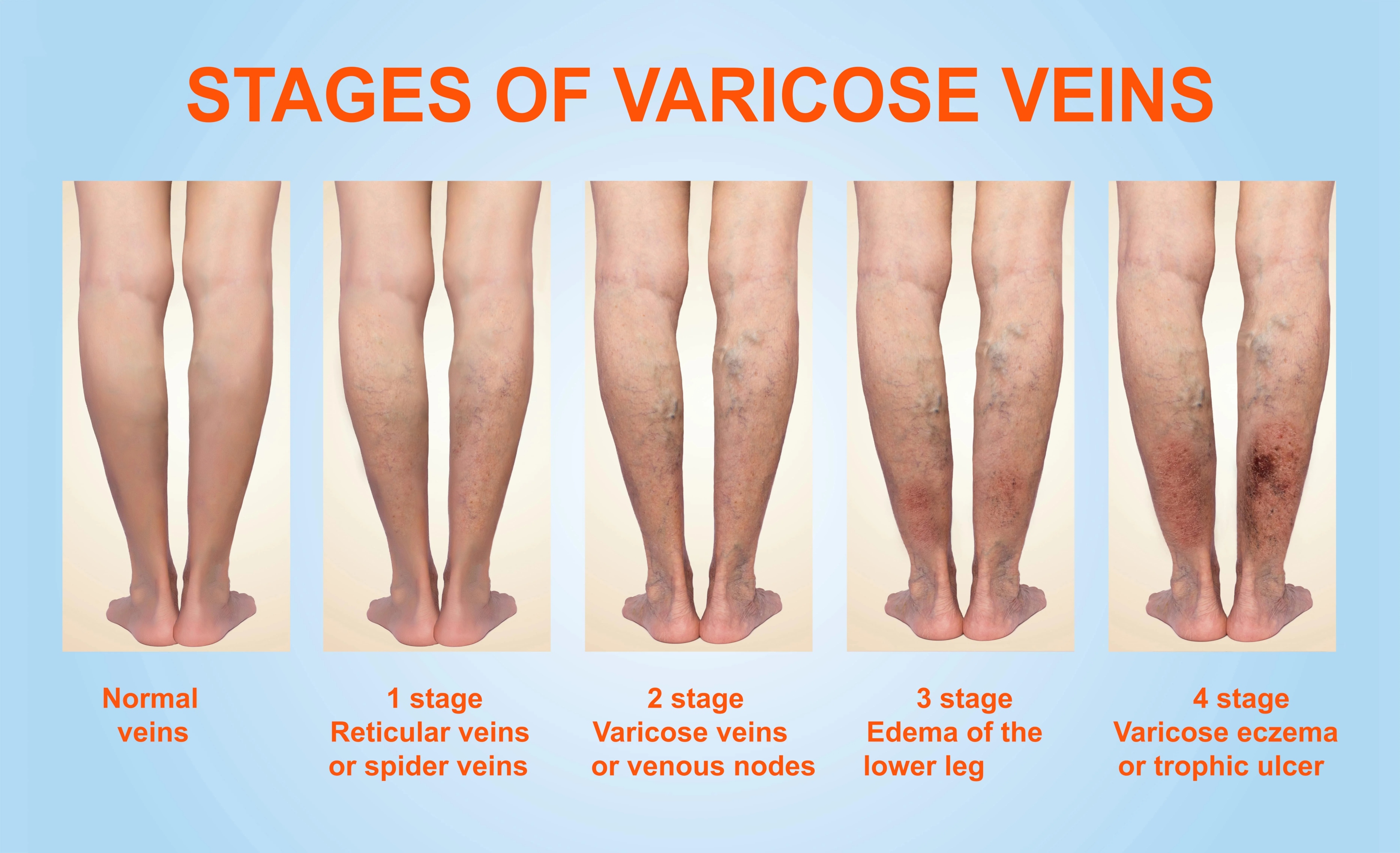 stages of varicose veins on the legs of a patient
