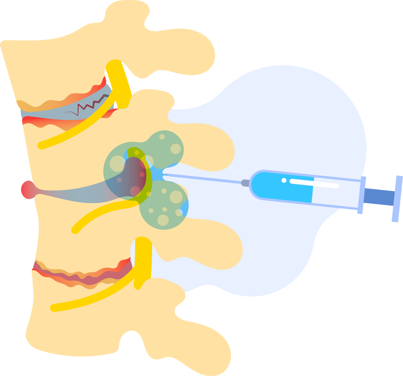 spinal stenosis treatment