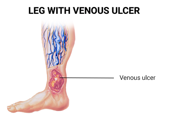 Vein Treatment At Vascular Institute