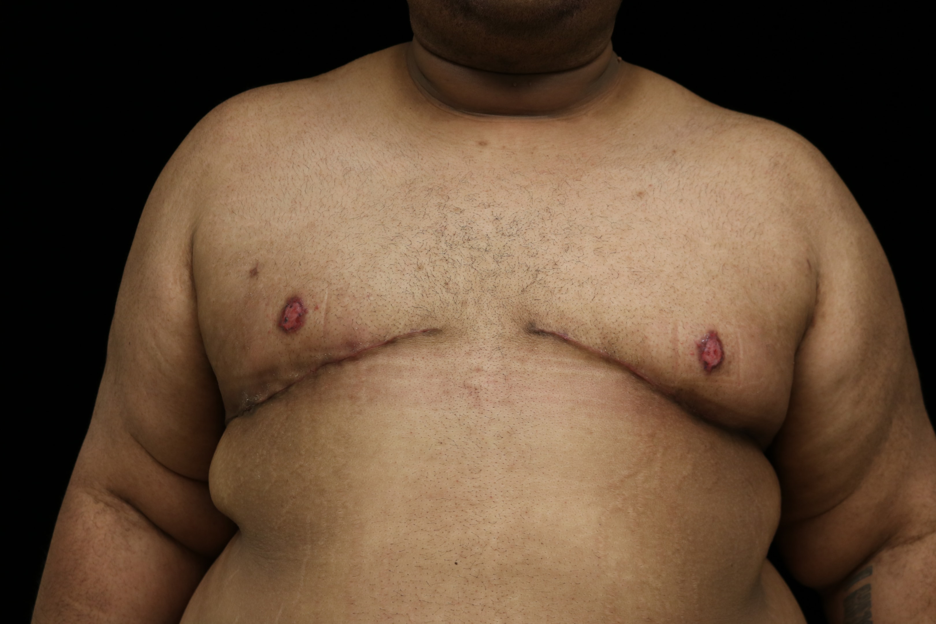 Same patient after a double incision mastectomy with a free nipple graft.