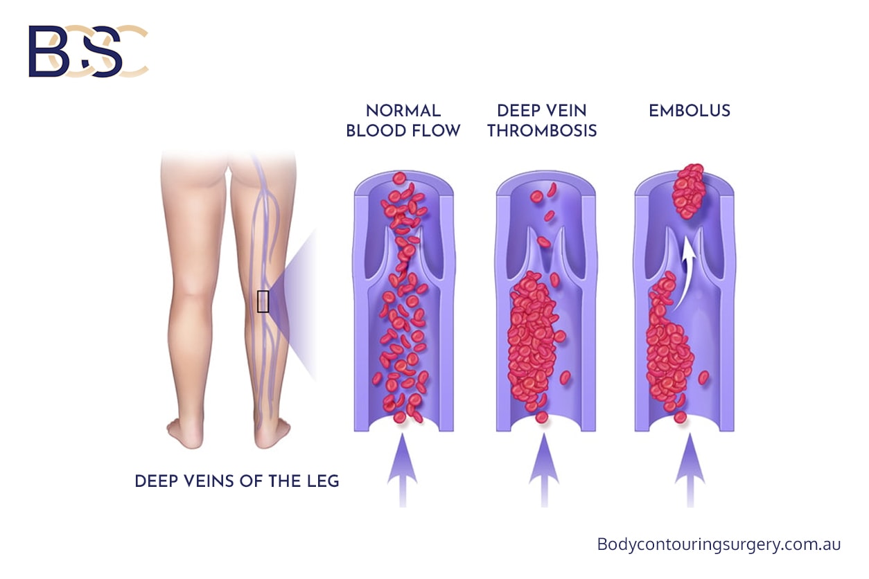 DVT | Body Contouring Surgery Clinic