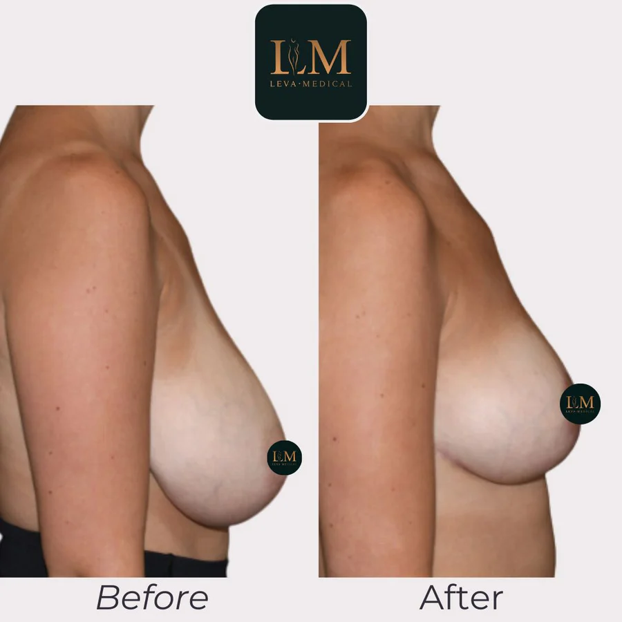 Una mujer con un levantamiento de senos sin implantes, mostrando una apariencia y sensación natural