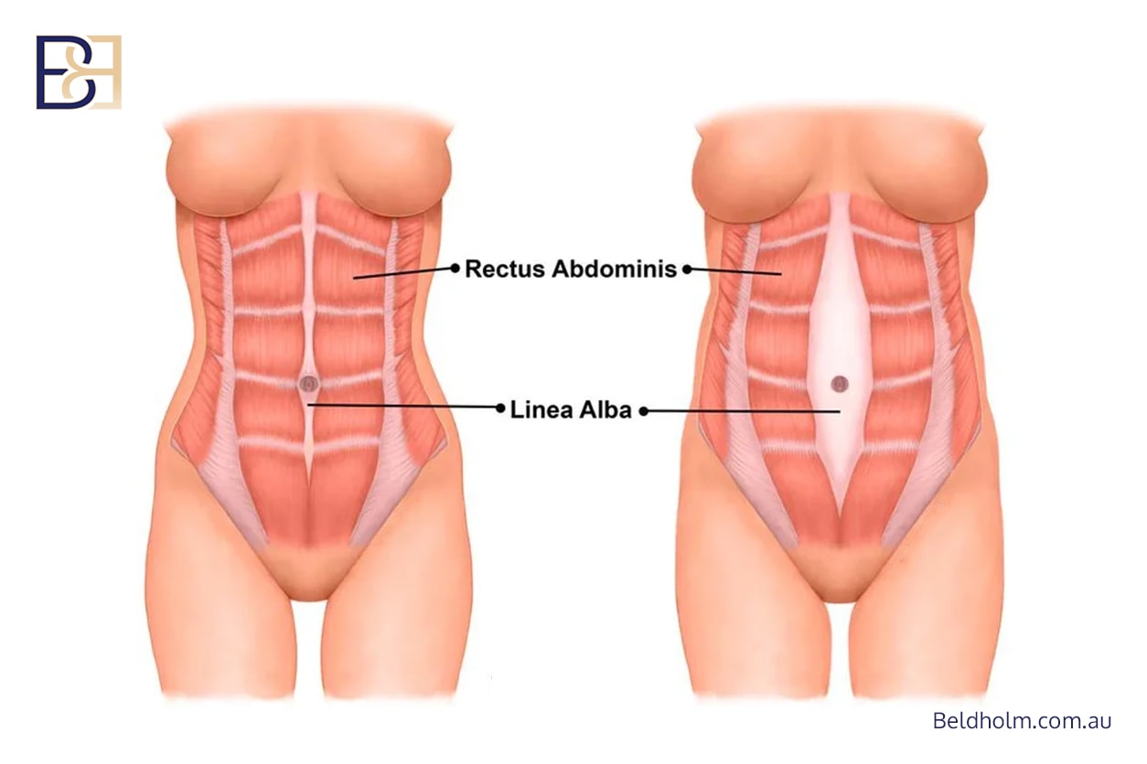 Diastasis recti