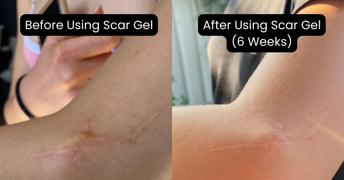 Surgicla Scar Before and After