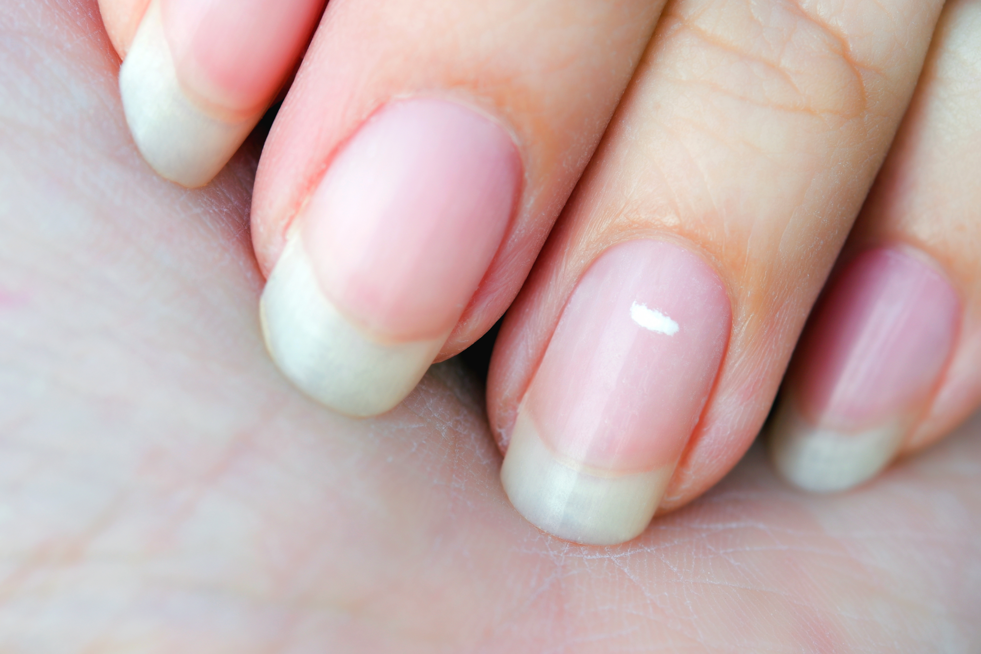 Photograph of nails with leukonychia.