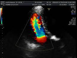 Leaking Mitral valve