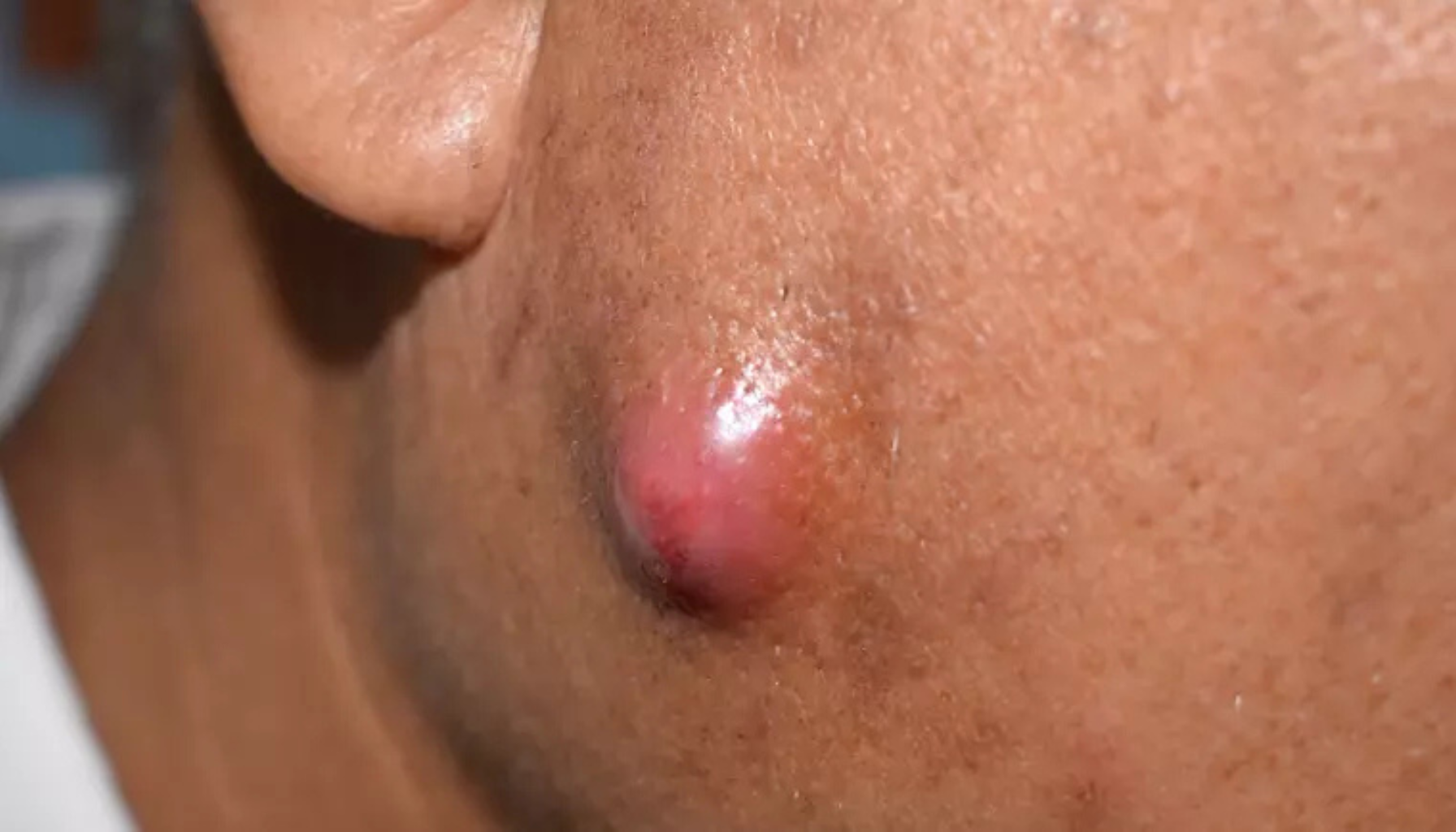 Hoven, rød byll i huden med ømhet og varme.