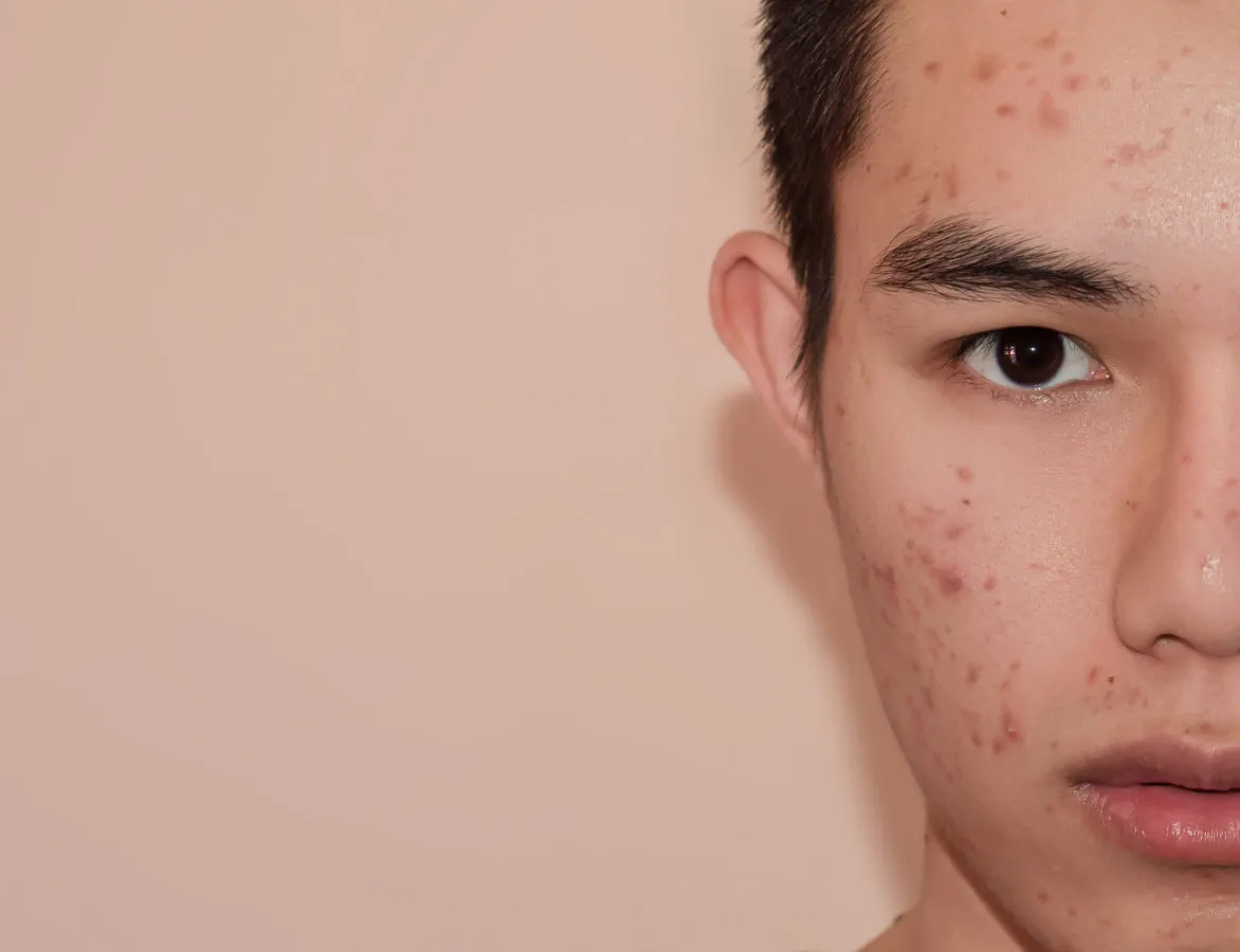 A person with pimples and acne in small amount