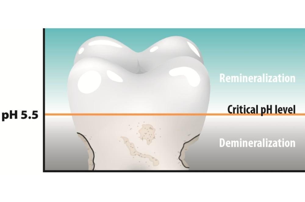 Critical pH balance of the mouth for remineralisation and demineralisation