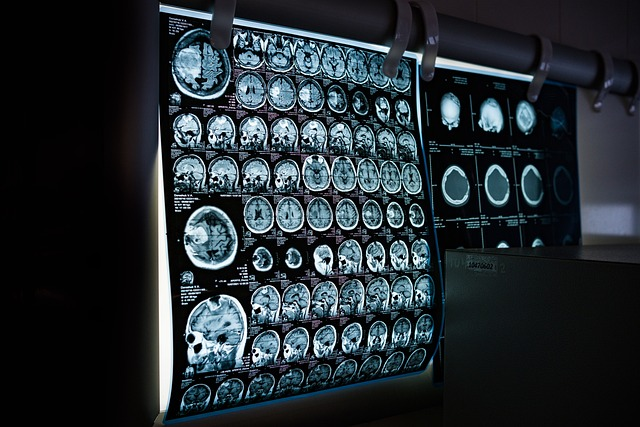 MRI brain scan image.