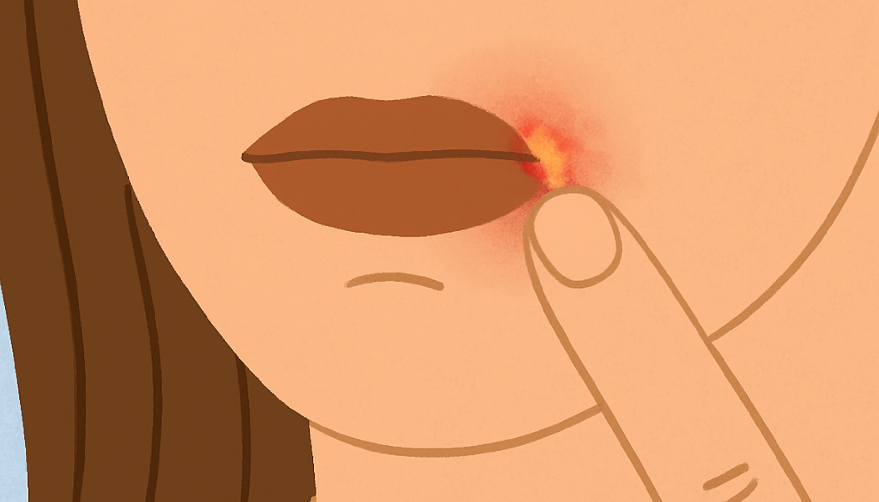 Sår i munnviken – Hva skyldes det og hvordan bli kvitt det? 12 Illustrasjon av munnvik med sår og betennelse, der en finger peker på det irriterte området på huden.