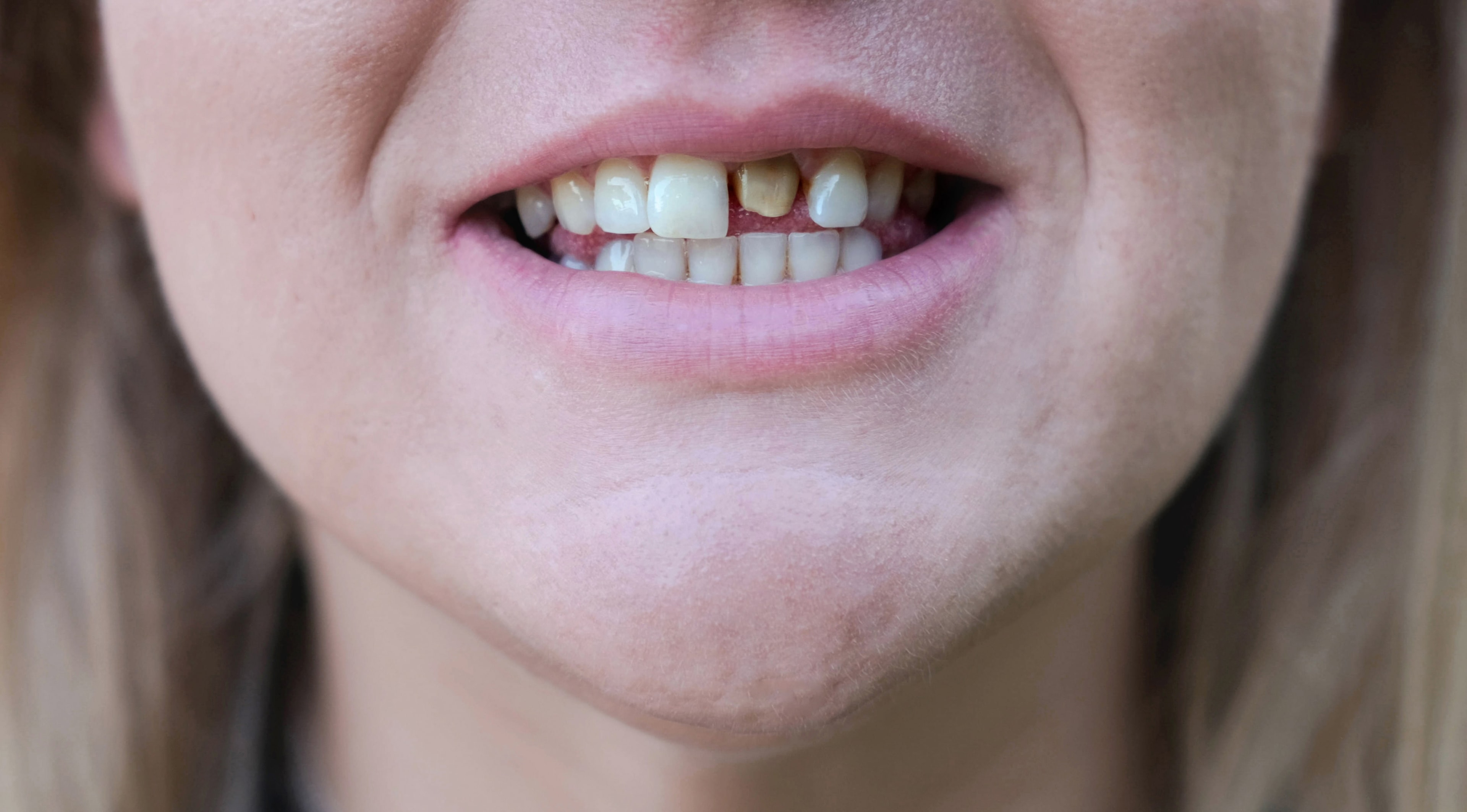 Woman's smile with a bad tooth. Teeth before treatment. Close-up.