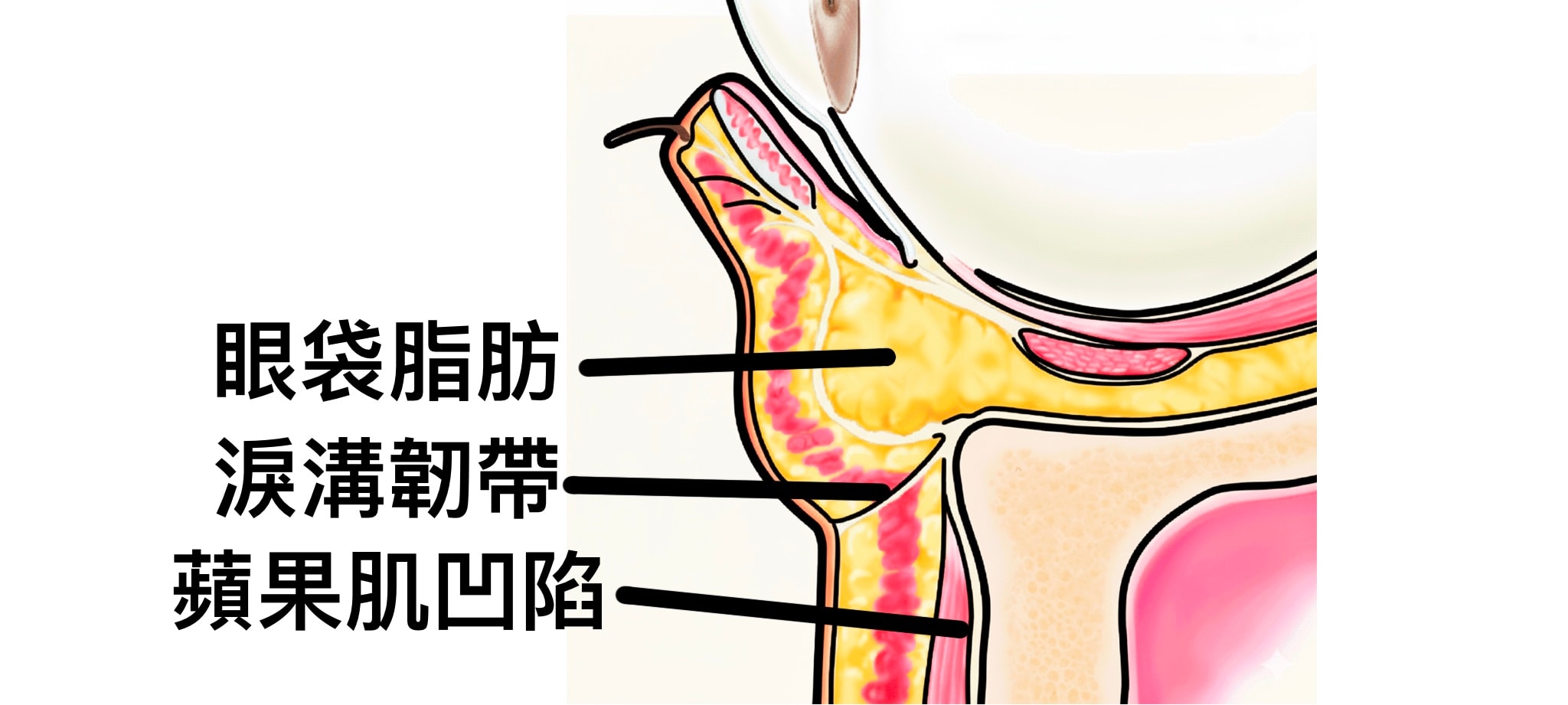 眼袋是由眼袋下方膨出的脂肪構成，淚溝韌帶是一個正常的韌帶組織構造
