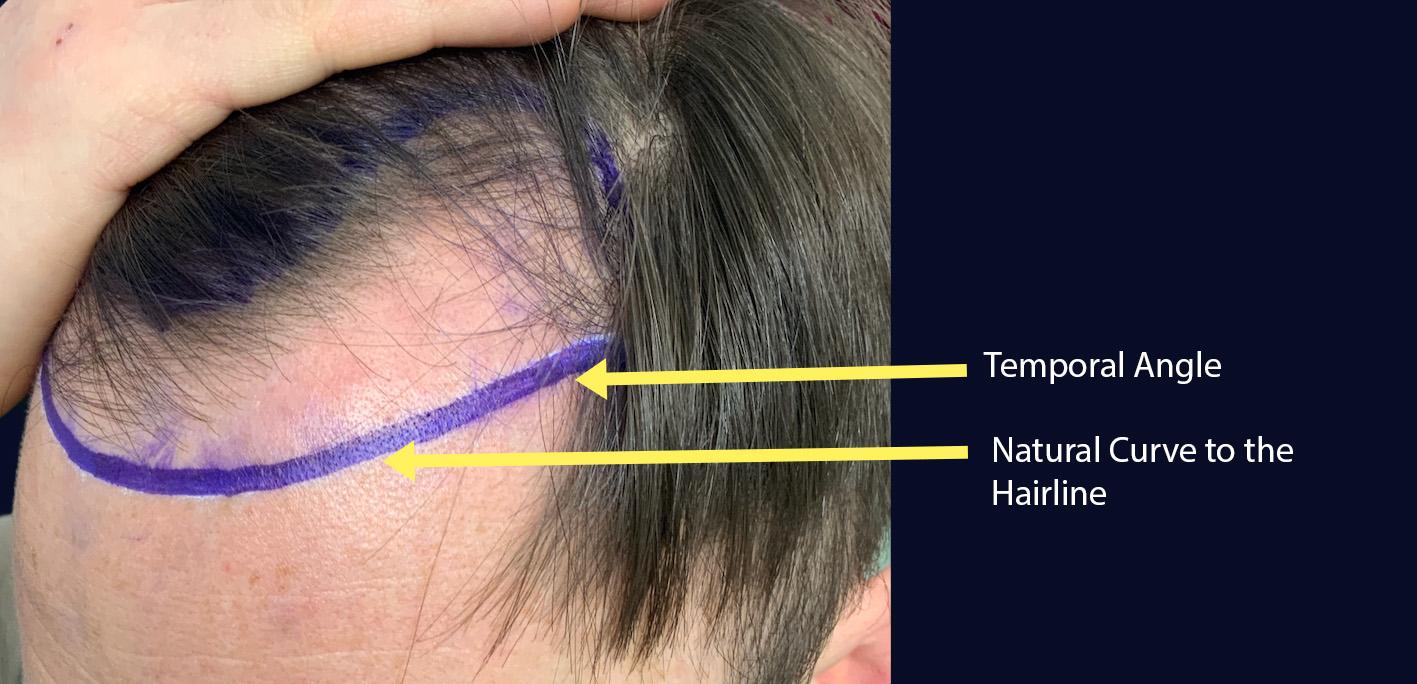 Dr Kunnure Clinic - Hair Transplant - Hairline Design