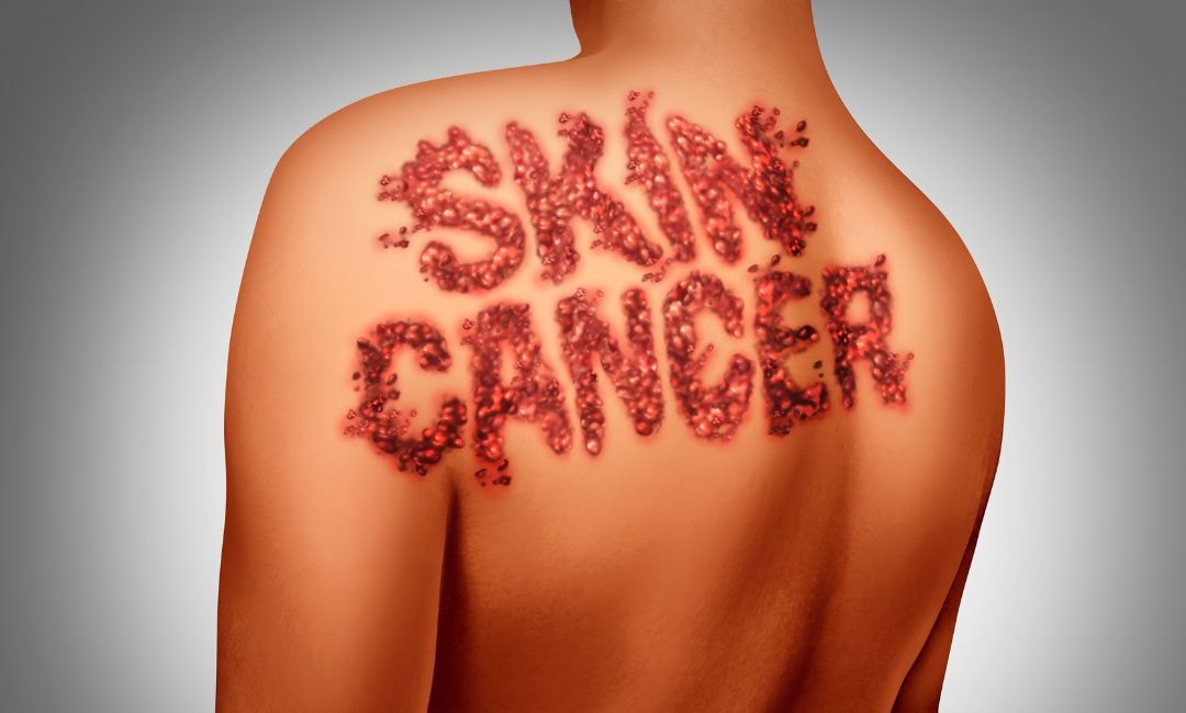 skin cancer prevention awareness