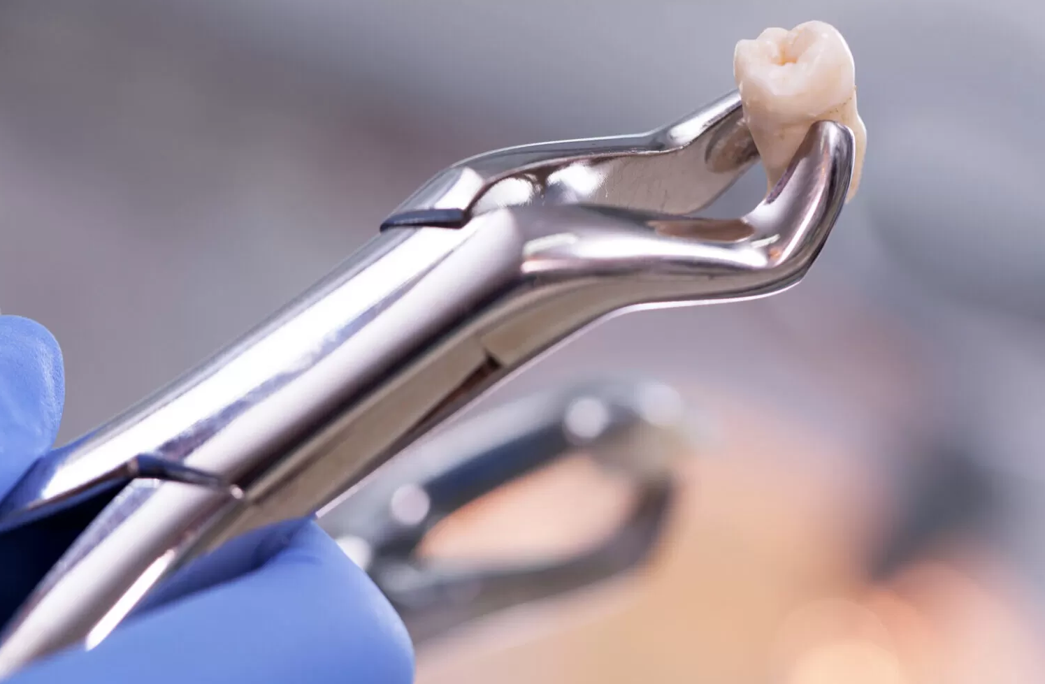 Simple extraction for wisdom tooth