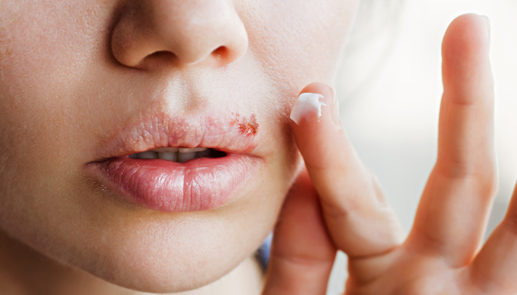 Nærbilde av munnsår på overleppen, mens en finger påfører hvit salve for behandling av herpes simplex-infeksjon. Ask ChatGPT