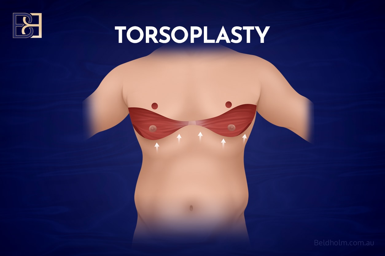 Anterior torsoplasty